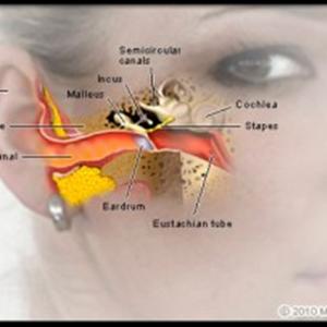 Tinnitus And Hyperacusis 